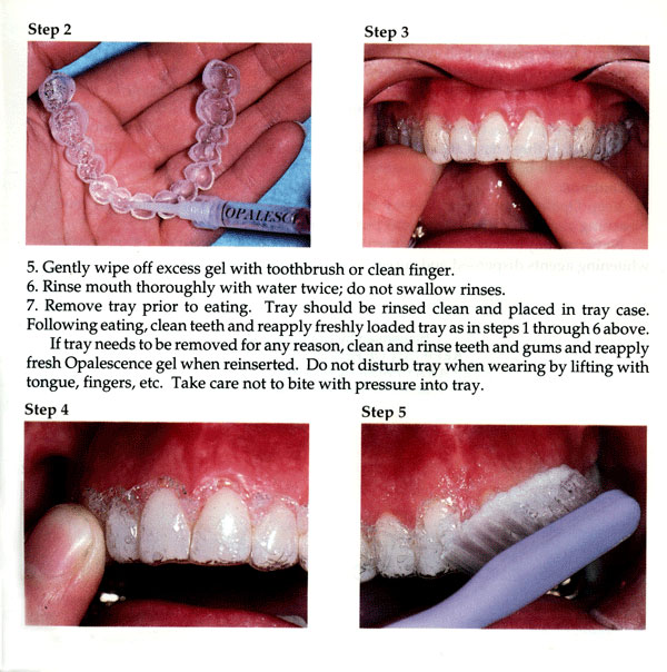 teeth whitening from dentist instructions
