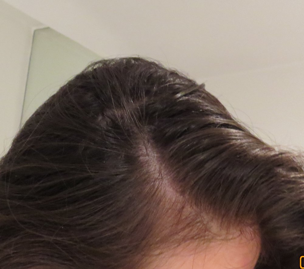 Telogen effluvium hair loss how to fix